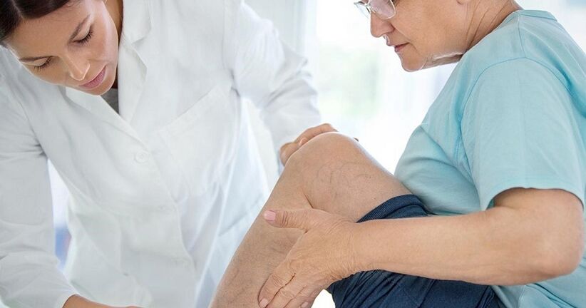 Se observan venas varicosas en cada segunda persona