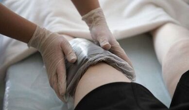 Métodos populares para tratar las venas varicosas en las mujeres