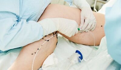 Métodos de tratamiento de venas varicosas en las piernas en mujeres