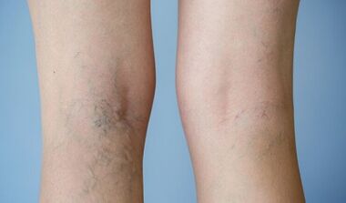 Signos de venas varicosas en las piernas en mujeres