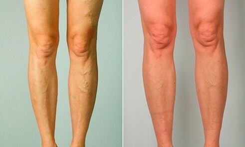 Antes y después del tratamiento de varices.