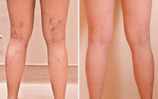 piernas antes y después del tratamiento de venas varicosas