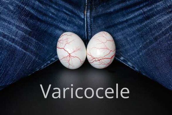 Varicocele dilatación de las venas del cordón espermático.